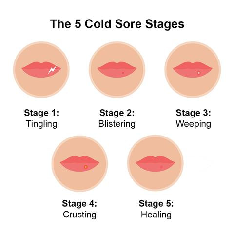 The 5 Cold Sore Stages: A Step-by-Step Guide