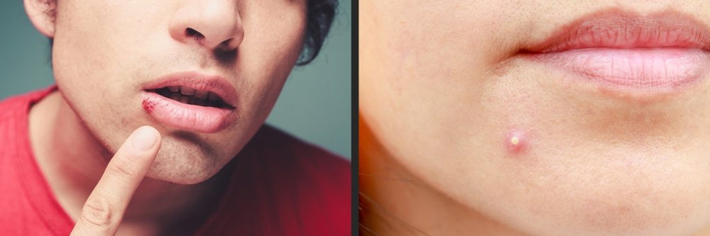 Cold Sore vs. Pimple: How to Tell the Difference