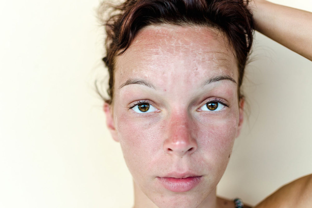 Be Careful When Treating Your Acne With The Sun Luminance Red