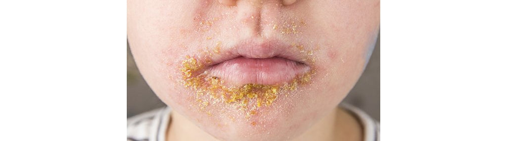 Impetigo vs. Cold Sore: How to Care for Your Child's Skin Irritation