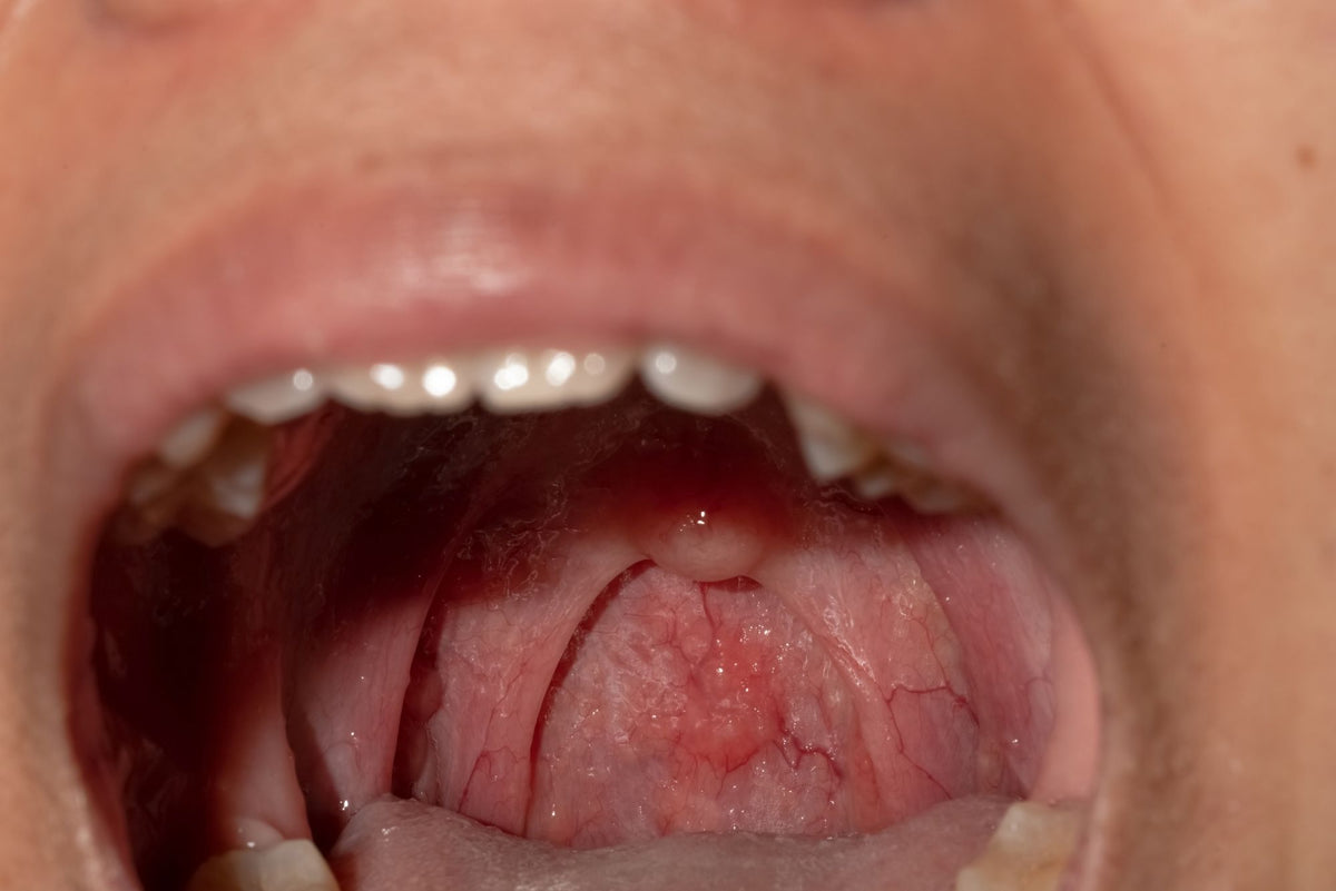 Canker Sore On Your Uvula Here s How To Tell And Find A Fix canker-sore-on-your-uvula-here-s-how-to-tell-and-find-a-fix