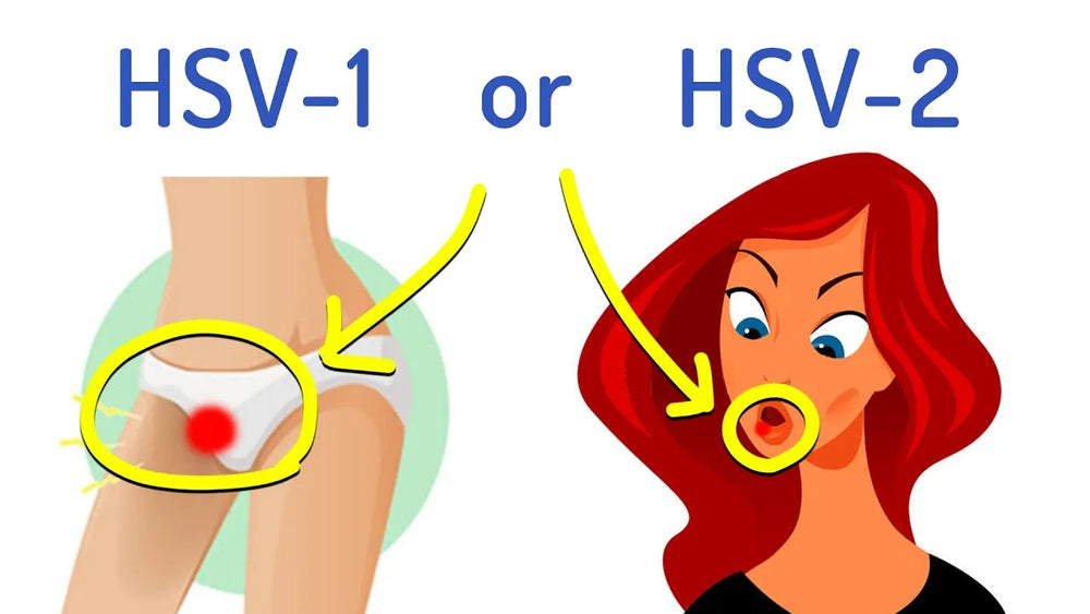 HSV-1 vs. HSV-2: Separating Facts from Myths