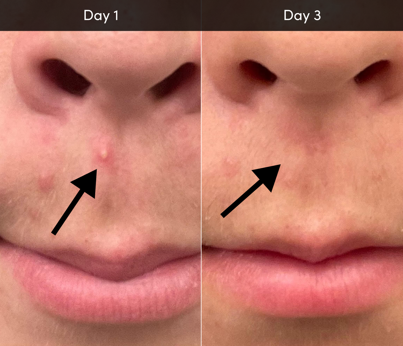 acne-before-guy