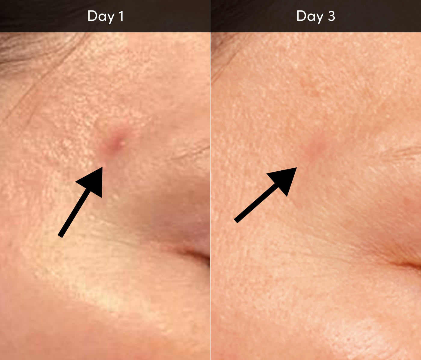 ance-before-after