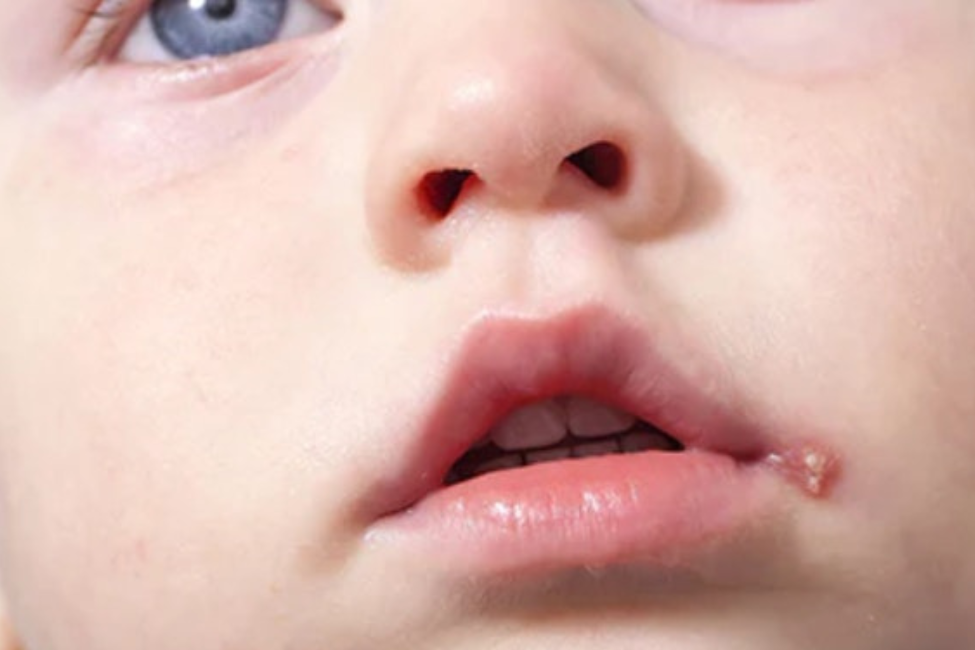 Neonatal Herpes Rash